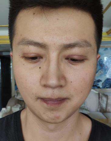 去眼袋手术
