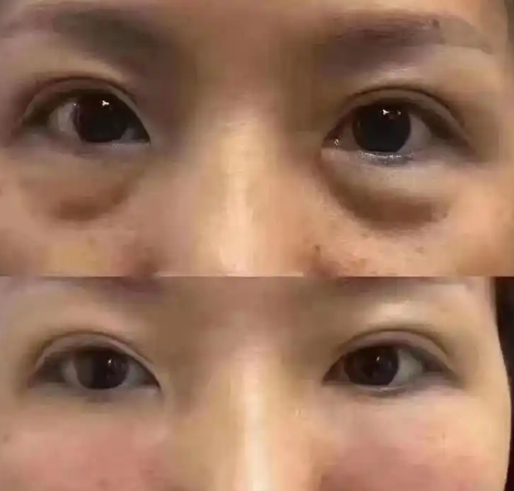 去眼袋手术