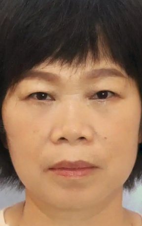 去眼袋手术