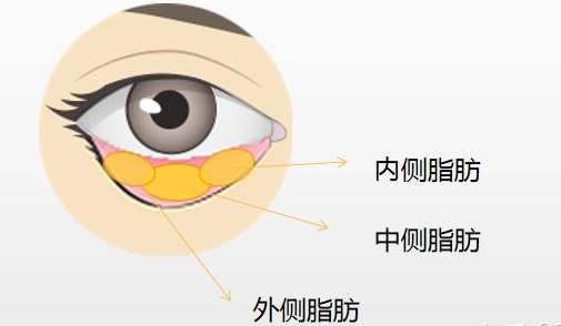 去眼袋手术