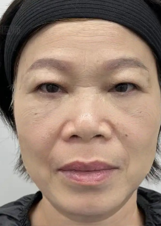 去眼袋手术