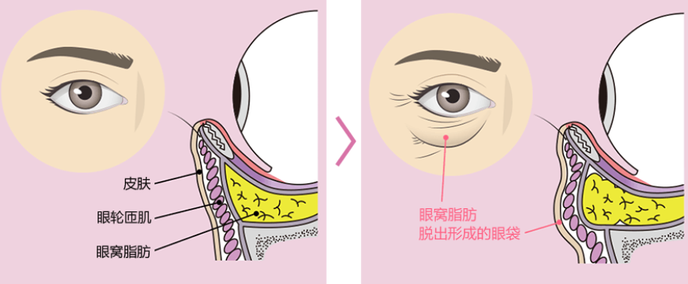 去眼袋手术