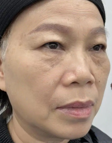 去眼袋手术