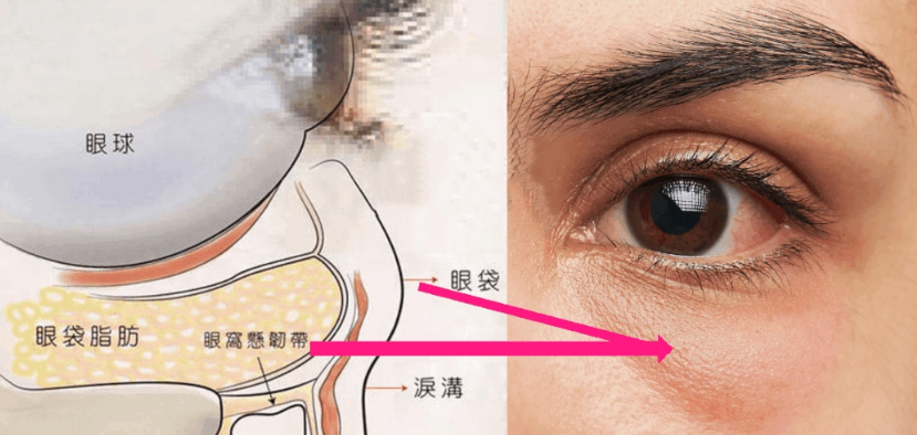 去眼袋手术