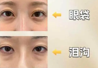 去眼袋手术