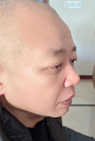 去眼袋手术
