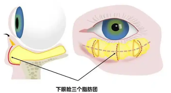 去眼袋手术