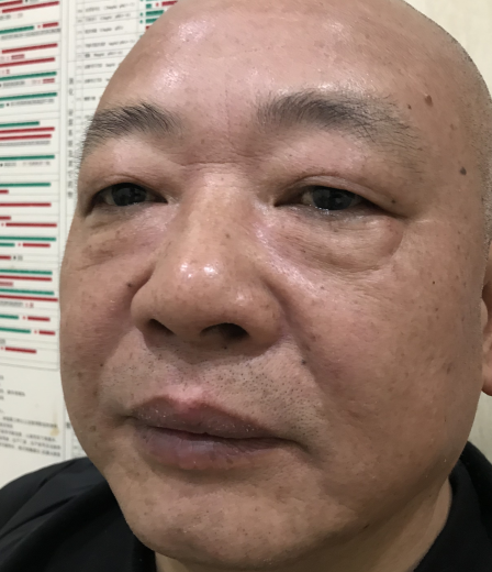 去眼袋手术