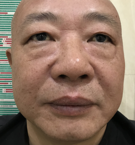 去眼袋手术