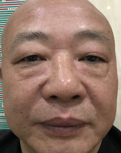 去眼袋手术