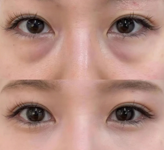 眼袋