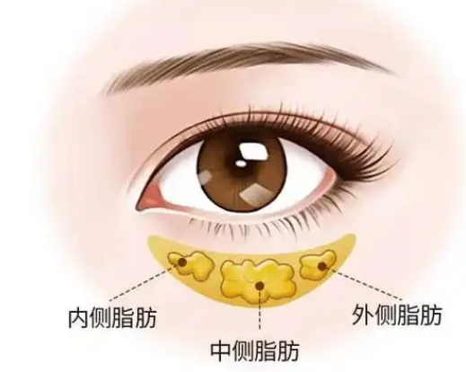 眼袋