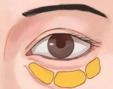 去眼袋手术