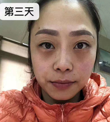 去眼袋手术