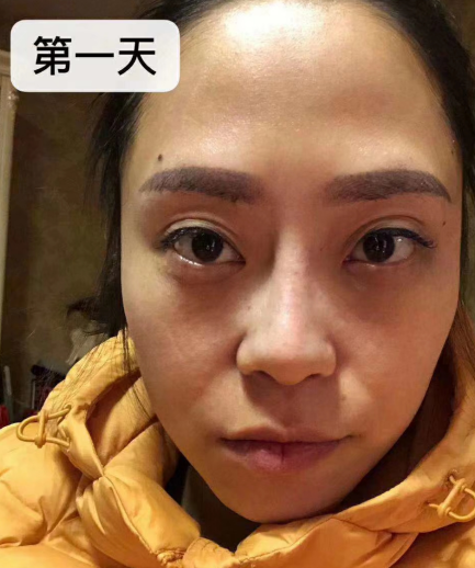 去眼袋手术