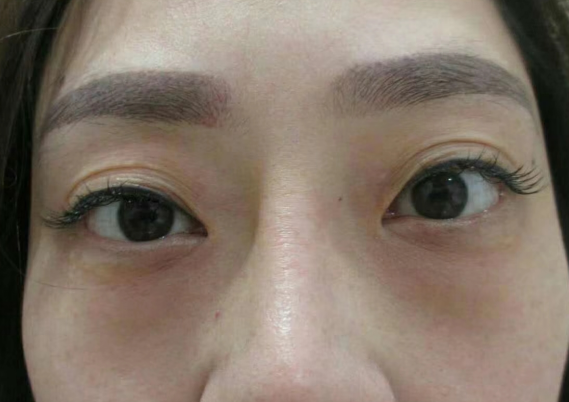 去眼袋手术