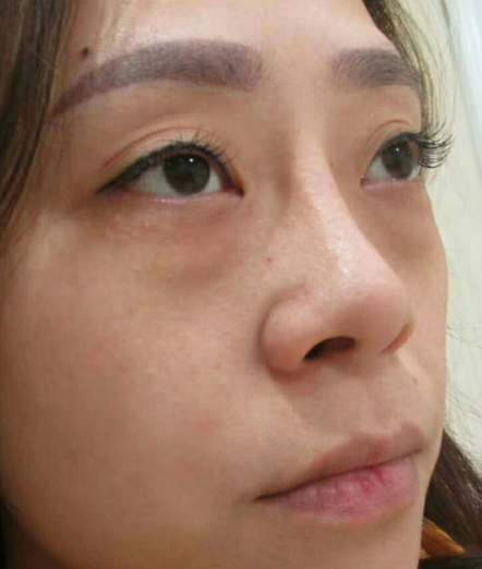 去眼袋手术