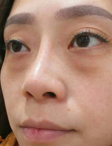 去眼袋手术