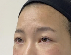 去眼袋手术