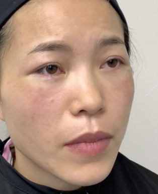 去眼袋手术