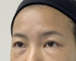 去眼袋手术