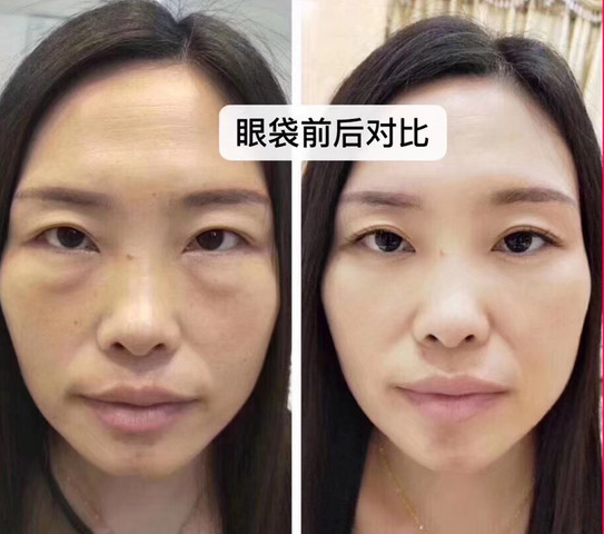 眼袋