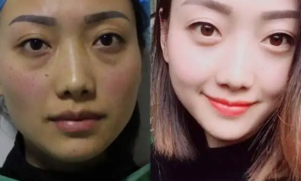 眼袋