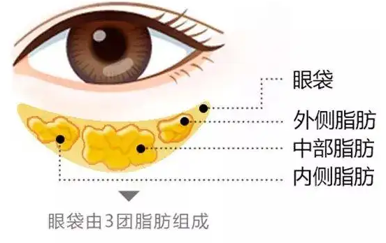 去眼袋手术