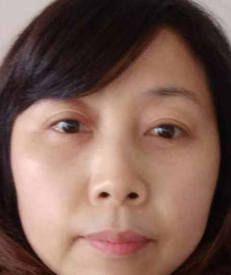去眼袋手术