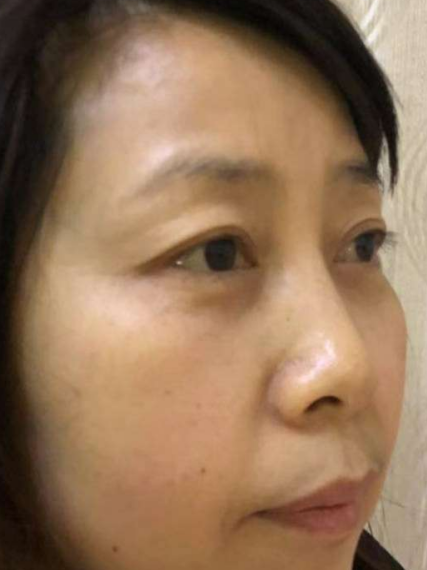 去眼袋手术