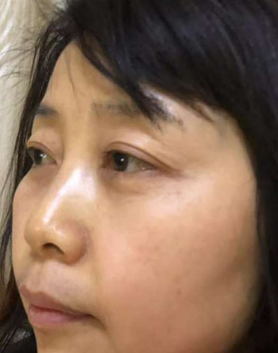 去眼袋手术