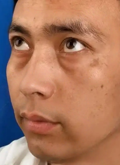 去眼袋手术