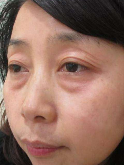 去眼袋手术