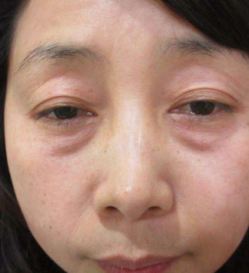 去眼袋手术
