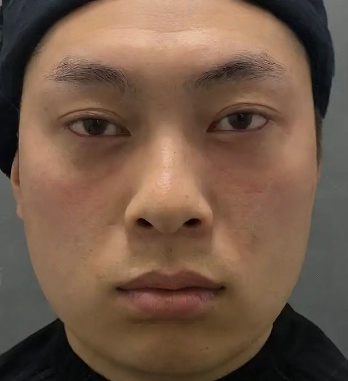 去眼袋手术