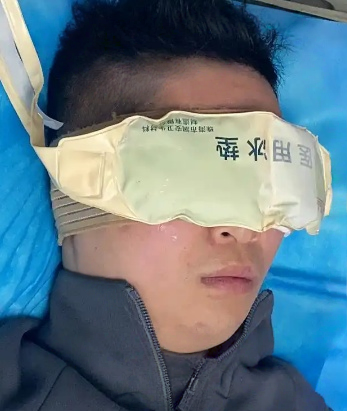 去眼袋手术