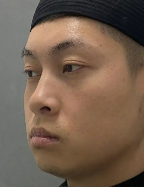 去眼袋手术