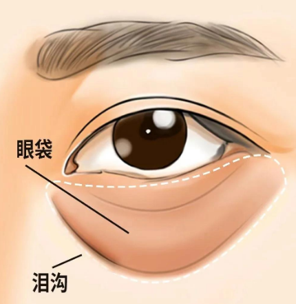 去眼袋手术