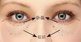 去眼袋手术