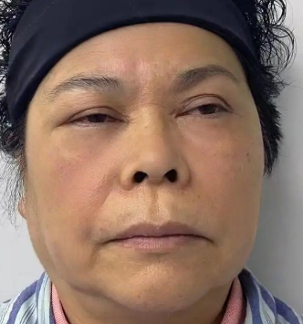 去眼袋手术