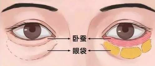 去眼袋手术