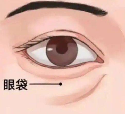 去眼袋手术