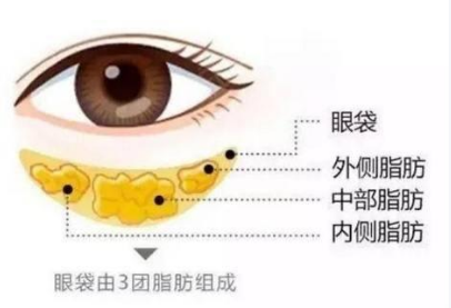 去眼袋手术
