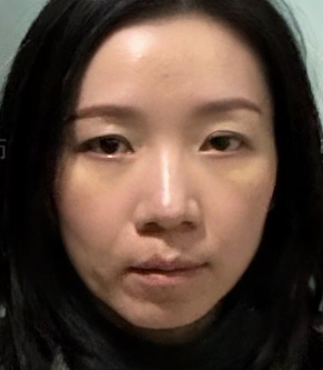 去眼袋手术