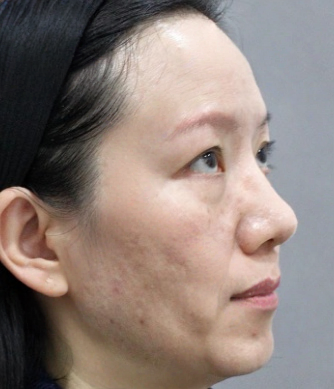 去眼袋手术