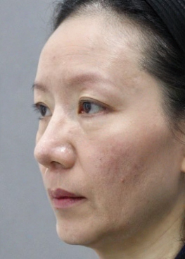 去眼袋手术