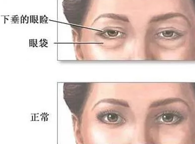 去眼袋手术