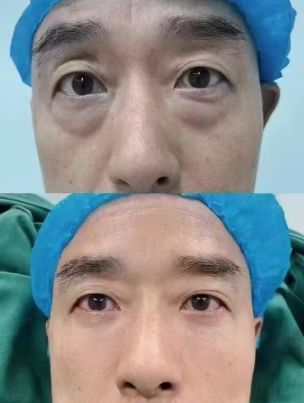 去眼袋手术