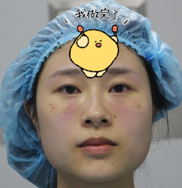 去眼袋手术