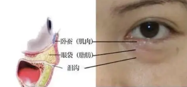 去眼袋手术